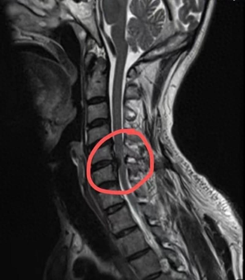 脊髓型颈椎病影像图片