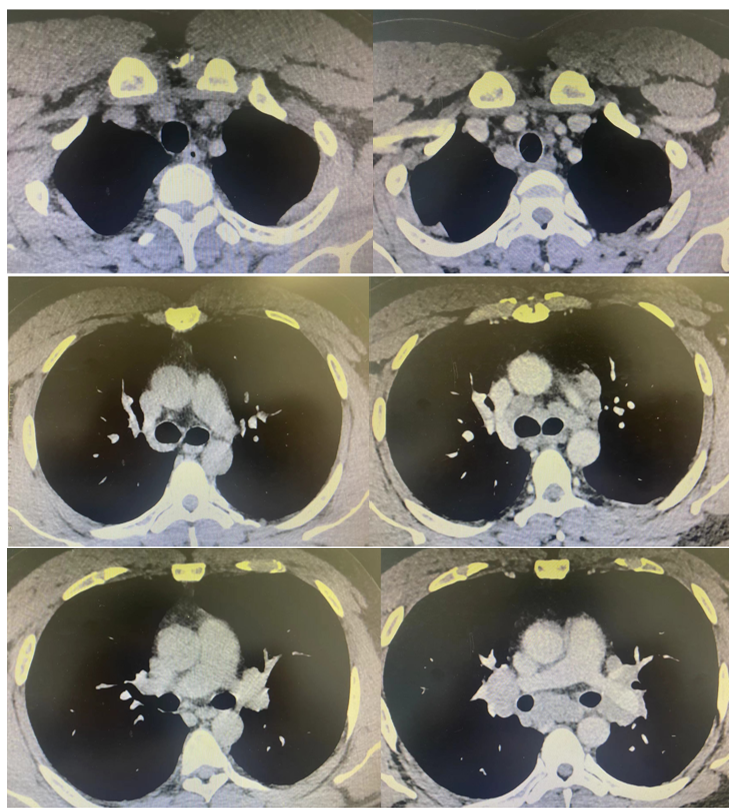 20年哮喘突遇反复发热,「纵膈多发淋巴结肿大」谜何解?