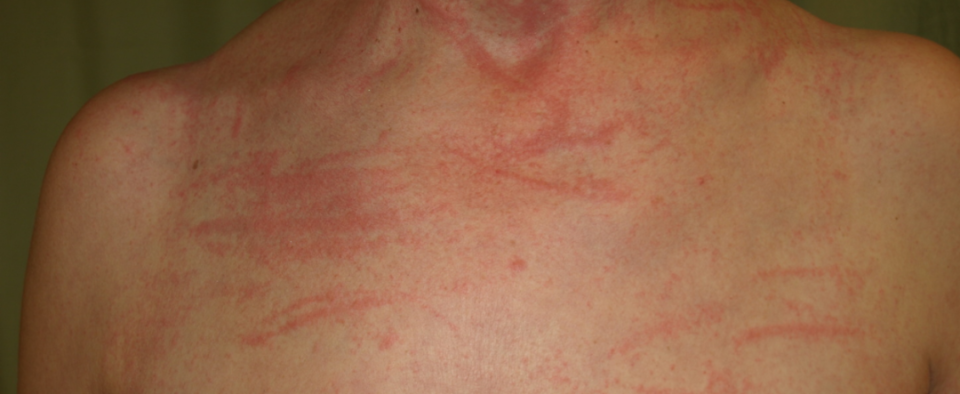 来自香菇的"鞭打"近些年,国内陆续报道了一些食用未煮熟香菇过敏案例.