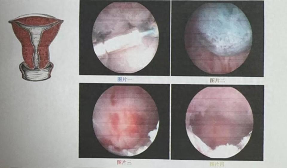 带环也有可能怀孕!医生提醒:有月经推迟要及时做检查
