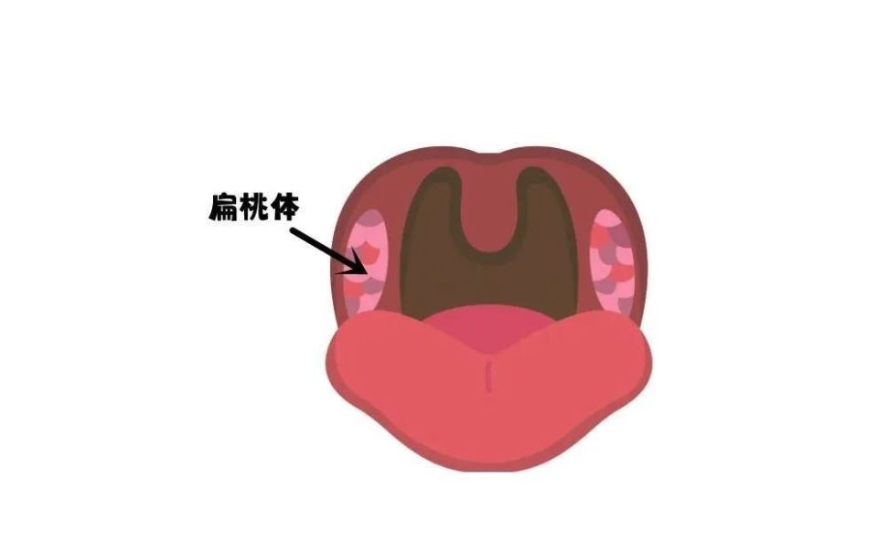 喝水像吞针扁桃体发炎竟查出恶性肿瘤