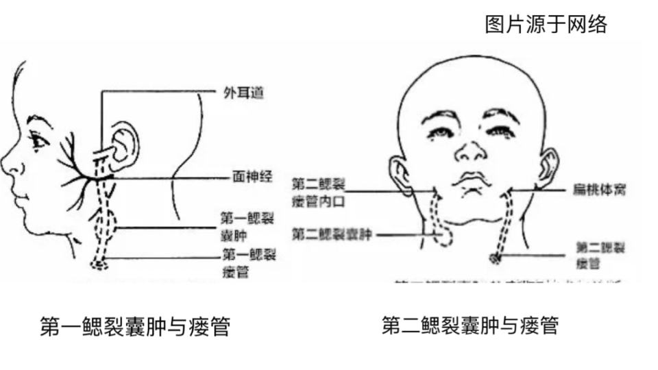 物呈豆腐渣样,其中,第二鳃裂瘘管最常见,常在胸锁乳突肌前缘有瘘口,细