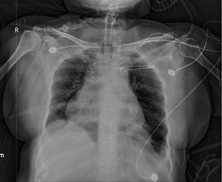 上海哪里买呼吸机好为何肺炎治好了，呼吸机却始终撤不掉？61岁阿姨ICU救治数月，左肺几乎无法正常工作，多学科协作如何“微创”破局？_https://www.jmylbn.com_新闻资讯_第2张