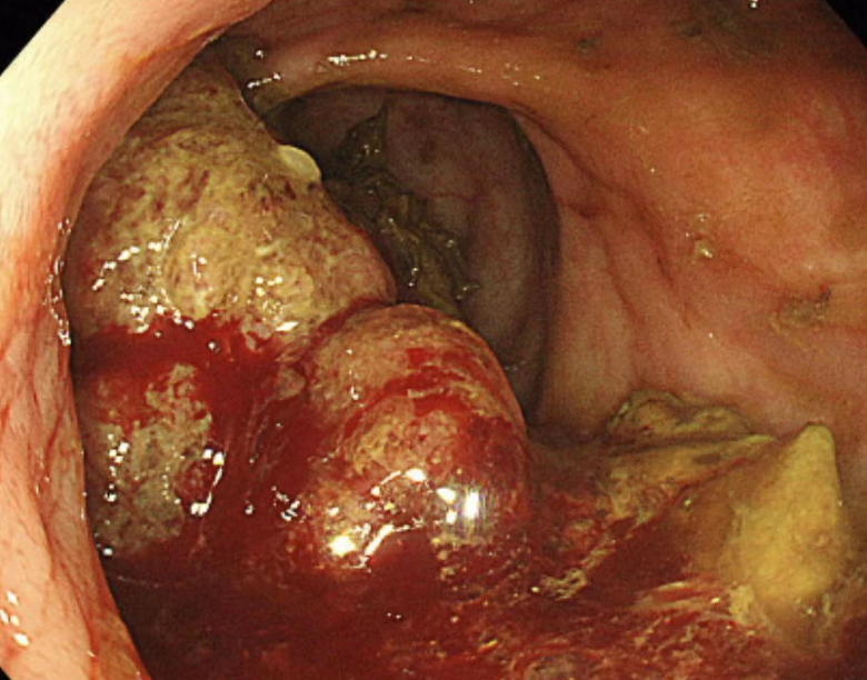 "小"内镜解决"大"问题,八旬老人不开刀治愈肠道肿瘤