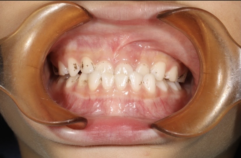 发现宝宝"地包天",什么时候矫正最合适?