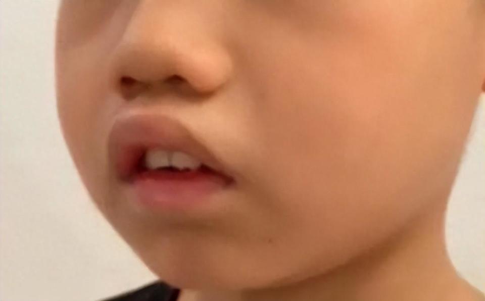 孩子腺样体肥大该怎么办?快来试试中医治疗吧!