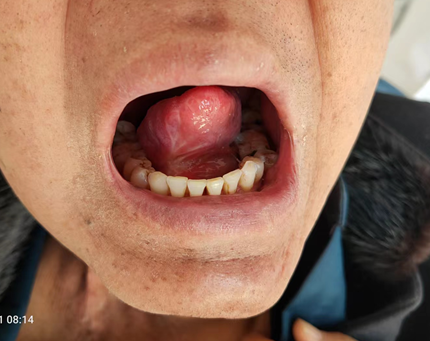 【鲁东医讯】口腔溃疡两个月,竟转成了癌?_腾讯新闻