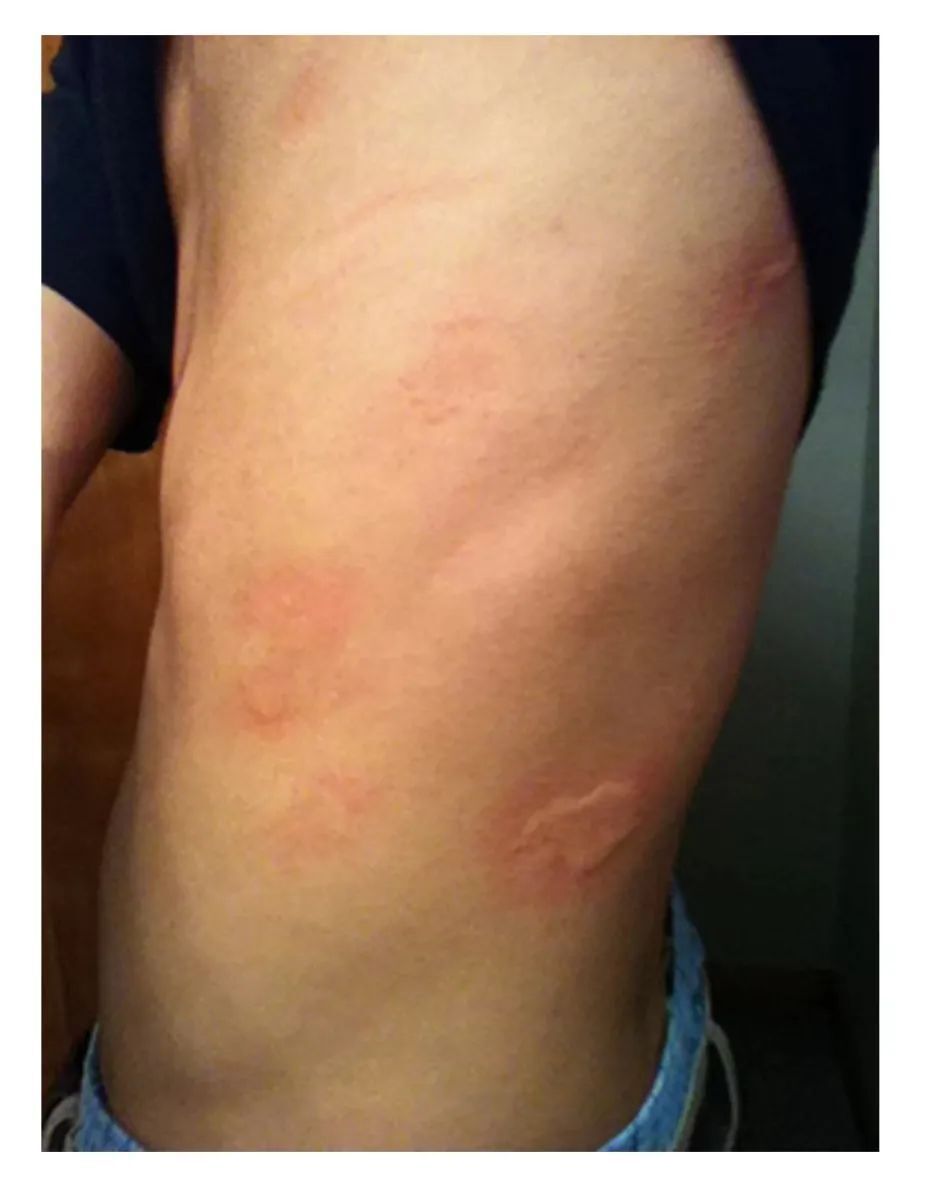 大众健康丨药师教你应对"荨麻疹"