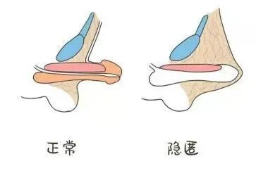 深藏不露的小"丁丁"?带孩子割包皮前,应先注意这一点