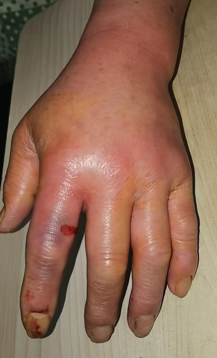 厨师被石头鱼扎伤,手指迅速肿痛!