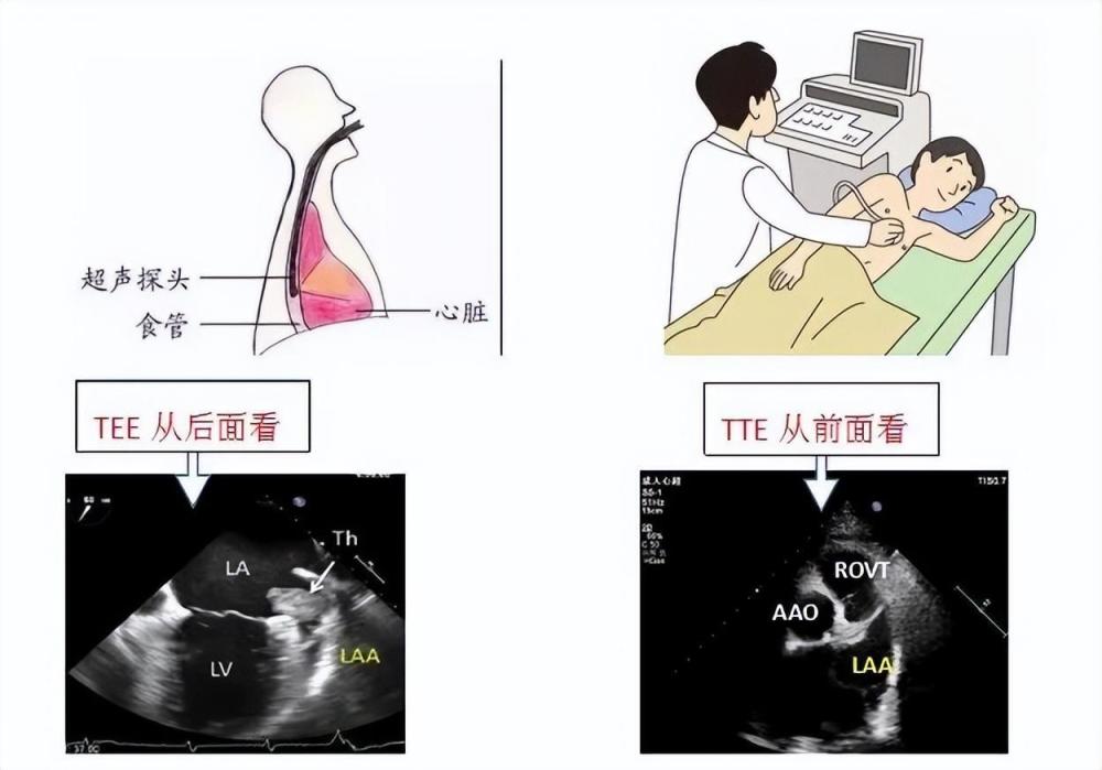 贴心检查经食道超声心动图带您从另一个视角探查心脏
