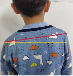 含胸驼背,高低肩.孩子这些"不良体态",您需要了解!