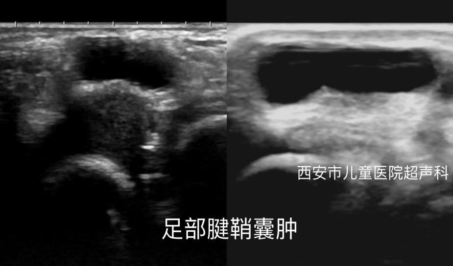 腱鞘囊肿该怎么治疗?