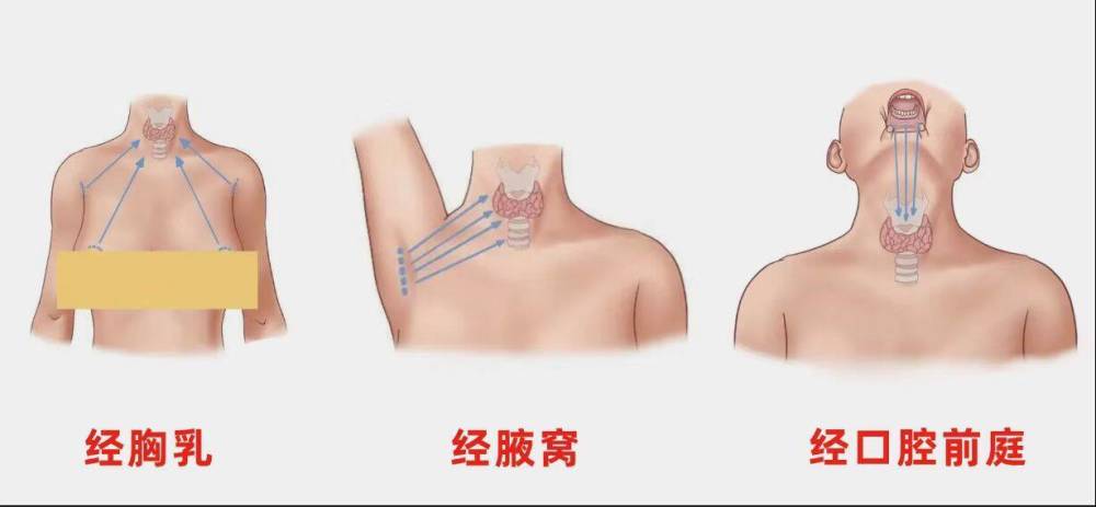 预告甲状腺手术刀过无痕怎么做到的