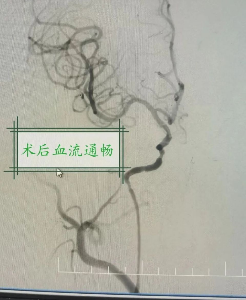 脑血管支架手术过程图片