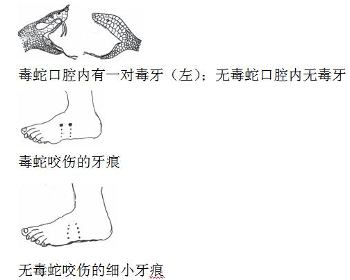 夏季蛇出没，医生提醒：被蛇咬伤记住18字救命要诀