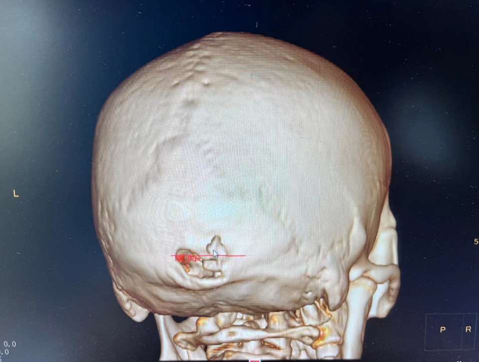后脑勺包块竟导致颅骨破坏?医生提醒:头部包块应及时就医评估