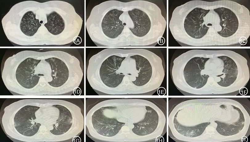 双侧胸膜增厚.主动脉及左冠脉管壁少许钙化.