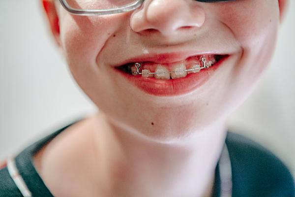 很多孩子并没有"天包地"和"地包天"这样的严重畸形,但也有牙齿不整齐