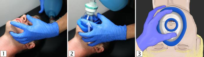 气管插管牙垫怎么放气管插管详细步骤（附多图）_https://www.jmylbn.com_新闻资讯_第6张