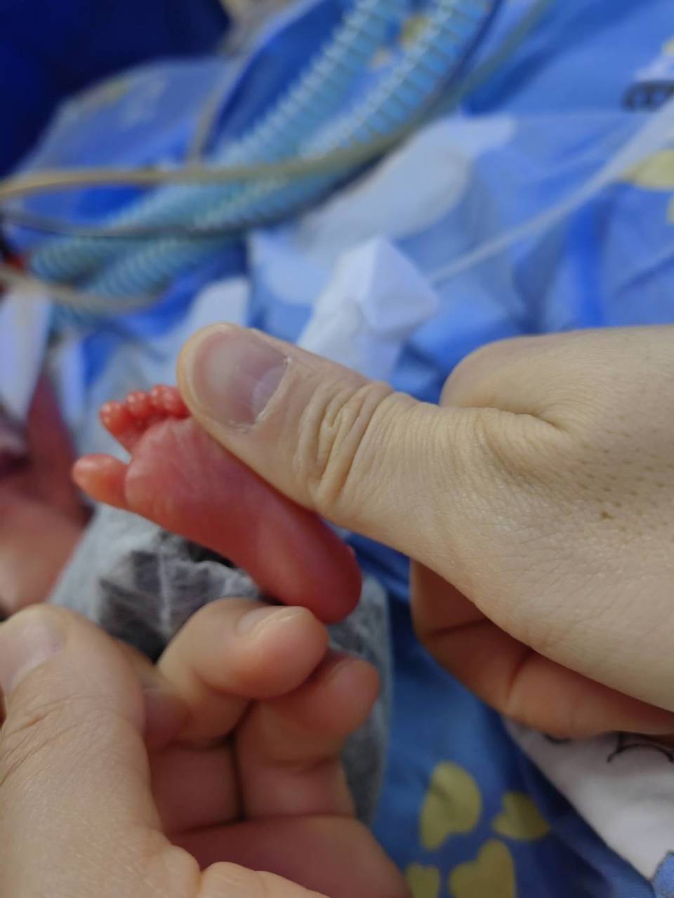 爱与守护的"生命奇迹":24周超早产儿成功存活出院