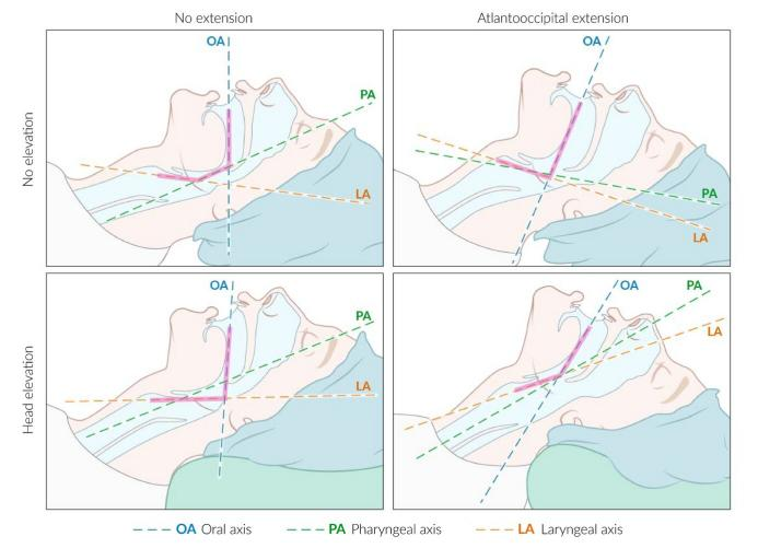 气管插管牙垫怎么放气管插管详细步骤（附多图）_https://www.jmylbn.com_新闻资讯_第4张
