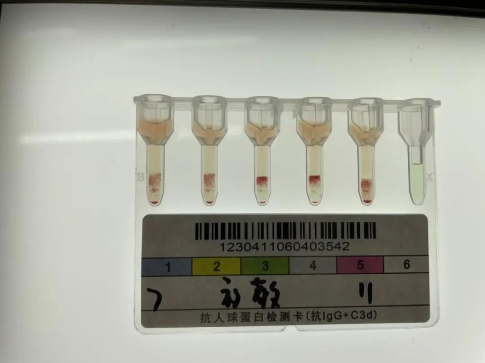 输血科的隐形杀手——迟发性溶血性输血反应