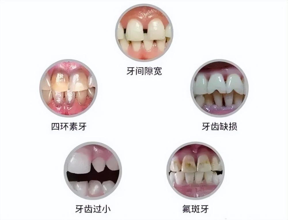 丹东牙齿修复 快速美白修复牙齿，只需这一点的改变