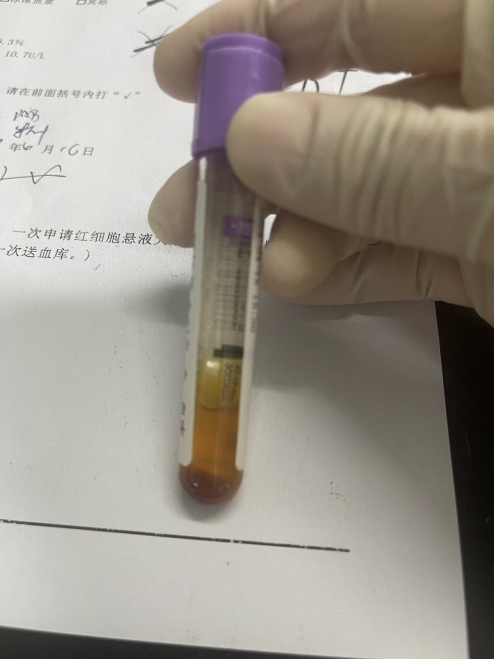 特别是当对高效价冷凝集素血液采取反向定型时,易将a,b,ab血型错误