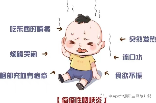 咽峡部疱疹溃疡:咽峡充血特别明显,舌腭弓,软腭,硬腭及悬雍垂处有灰白