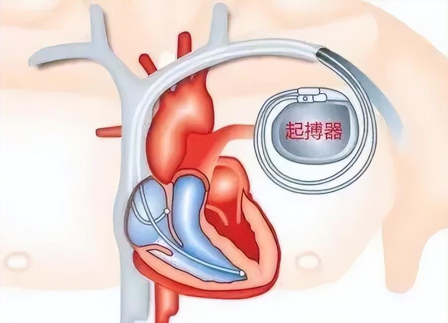 临起搏器安装部位图解图片