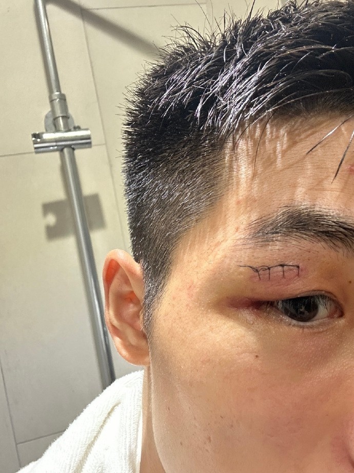 海港中卫魏震社媒晒伤口缝针照不容易让我们团结在一起