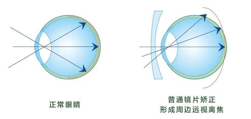"郑州爱尔眼科医院近视防控专家白鹏主任说道,"眼睛近视多是由于眼轴