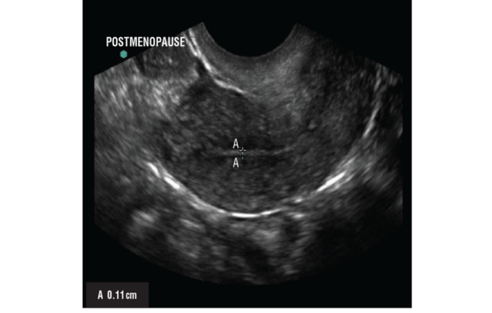 如果在检测时候发现异常的子宫内膜,应进行子宫内膜组织取样.