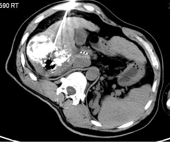 "名院名医话健康@哈密市肿瘤医院"系列4||肝癌晚期没开刀病灶就消失了