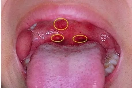 疼痛性丘疹-水疱-溃疡性口腔黏膜疹:体格检查可见到散布于软腭,悬雍垂
