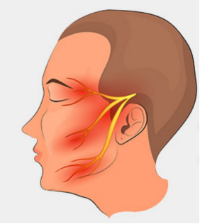 面神经炎俗称为面瘫,也称为面神经麻痹, 是一种原因不明的急性单侧