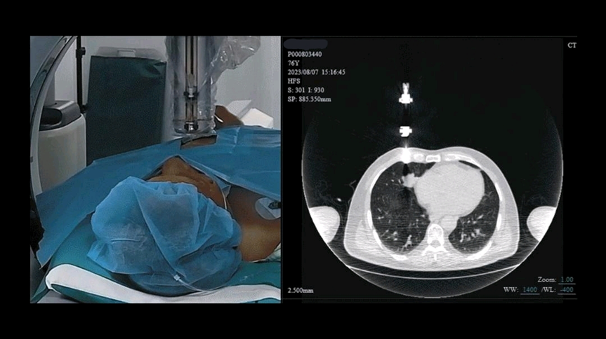 什么是联影ctCT引导介入手术边看边穿！联影集团又一全球首创_https://www.jmylbn.com_新闻资讯_第6张