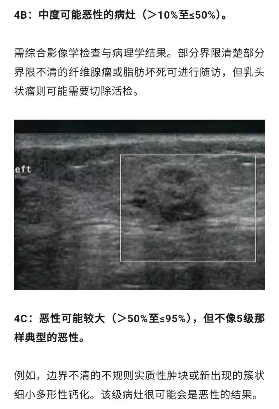 外上象限乳腺结节图片