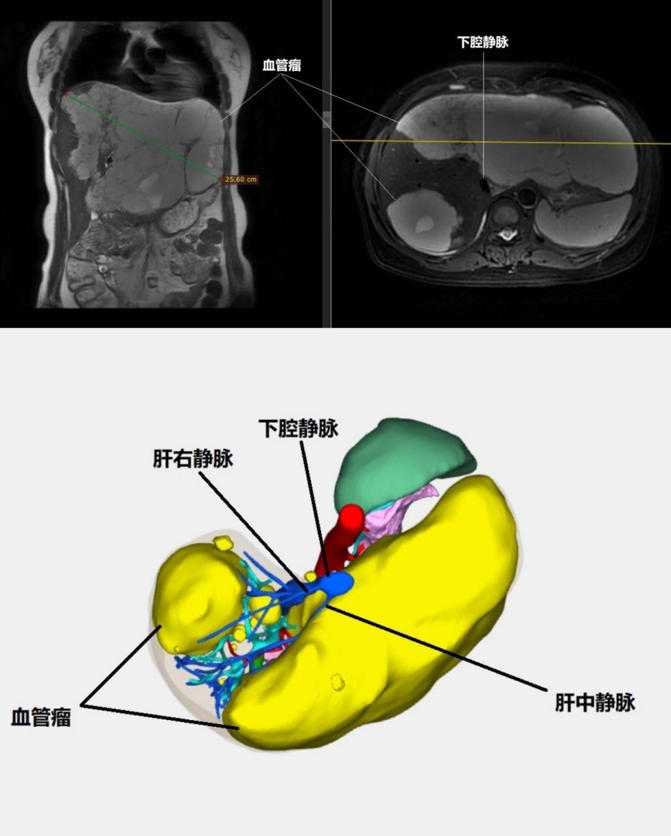 肝血管瘤 直径图片