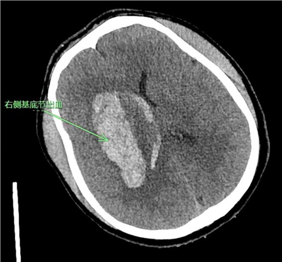 脑出血的ct表现图片图片