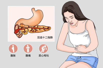 长假期间,徐女士(化名)在家中聚餐后,突然出现肚子胀,腹部疼痛的症状