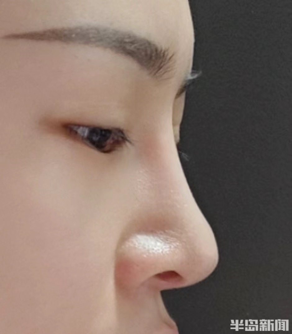 在壹美整形做小翘鼻整完鼻头下旋,四年后假体险些穿出皮肤