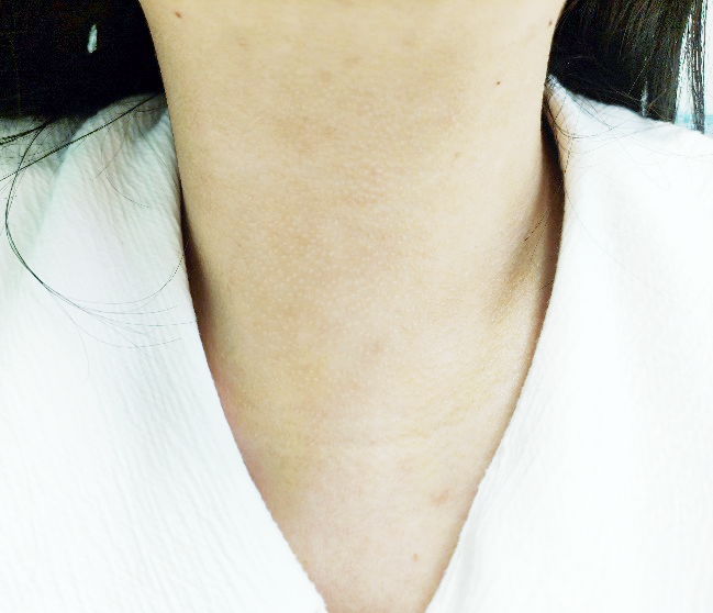 术前甲状腺Ⅱ度肿大,术后颈部无痕尽管长期接受治疗,但是她的甲状腺肿