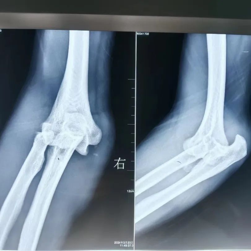 不再恐怖╫延安市人民医院骨科三病区高质量完成肘关节恐怖三联征手术