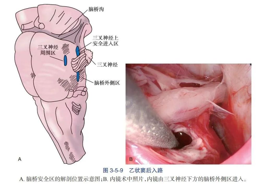 1)经枕下后正中-小脑延髓裂入路>到达第四脑室底(菱形窝>应用面丘上