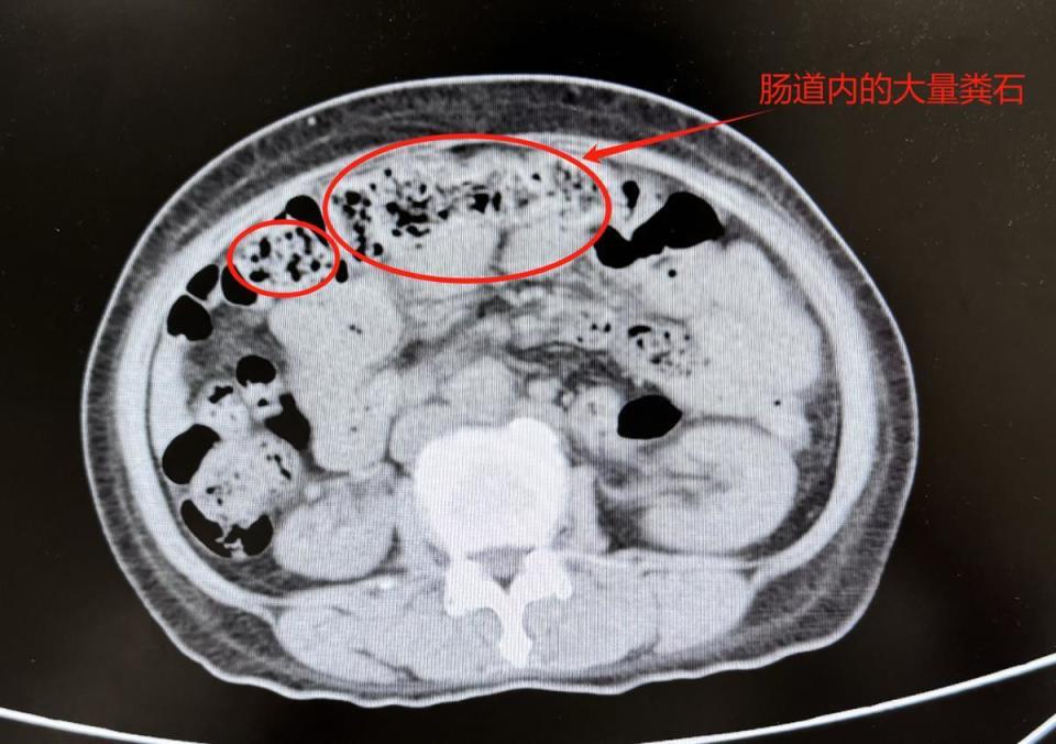 回盲部多发憩室图片