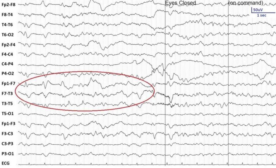 脑电图显示,广泛性周期性15hz放电