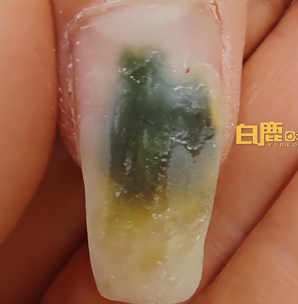 变绿店老板10个指头绿了6个大拇指指甲和肉分离劝她就医仍坚持做美甲