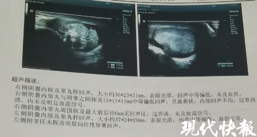 接诊的儿外科主任医师张敏查体后给出判断:"睾丸扭转"
